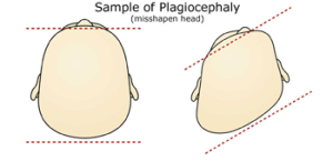 plagiocephaly head