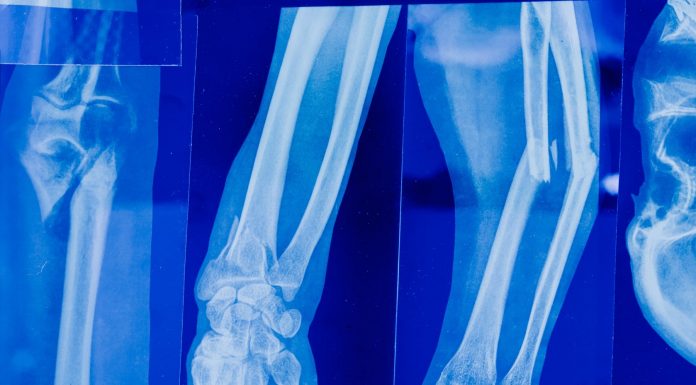 toddler broken bone xray, how to manage a toddler in a cast