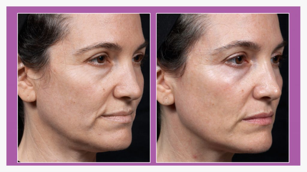 Before-and-after-radiofrequency-therapy-on-the-face-1296x728-slide1.jpg